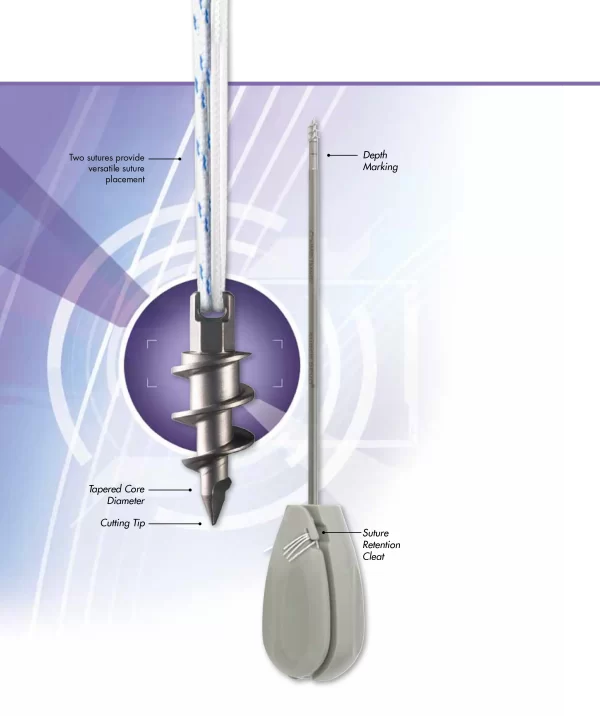 Sutura de Alto Rendimiento HiFi®: Reforzando la Reparación del Manguito de los Rotadores